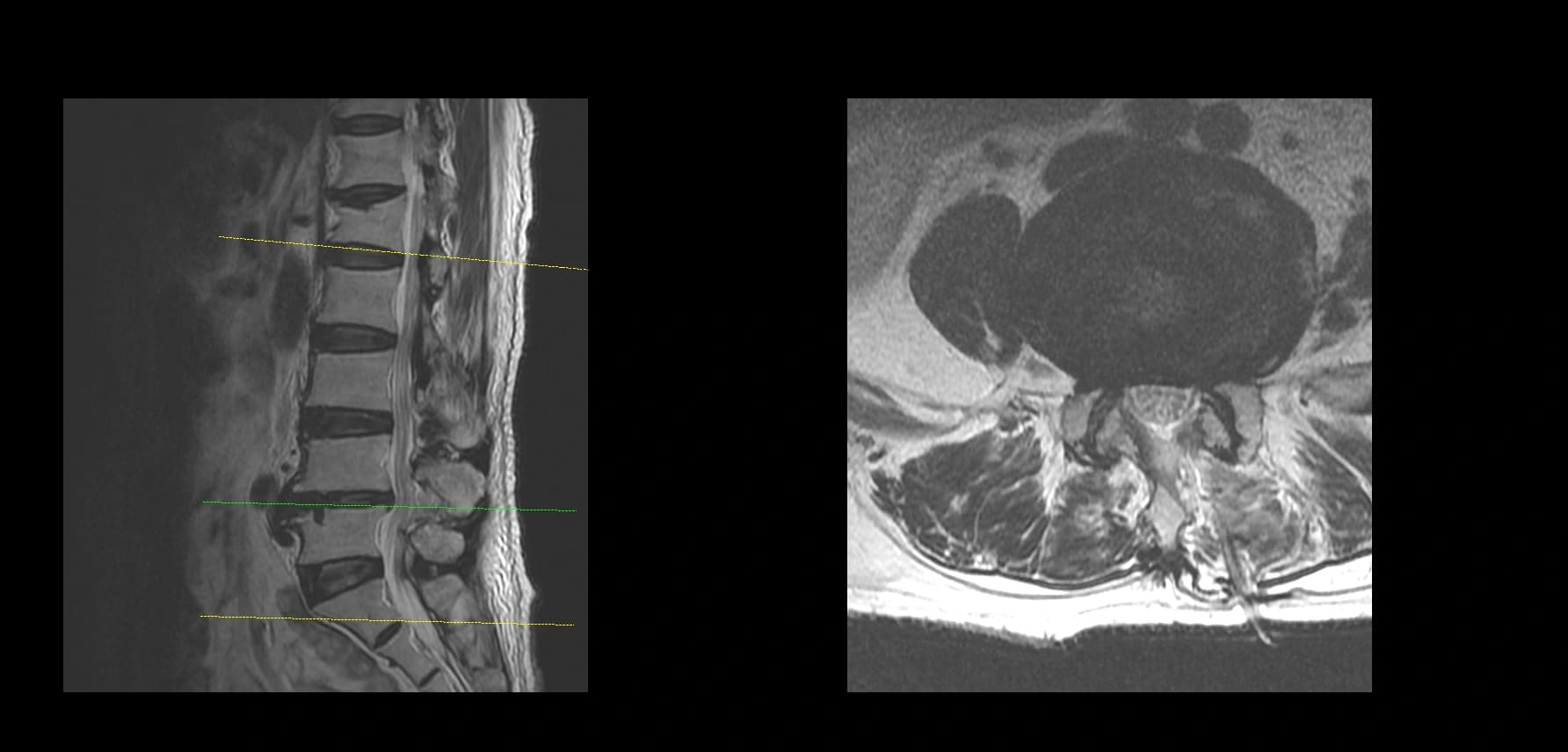 De-identified postoperative axial lumbar MRI after endoscopic decompression.