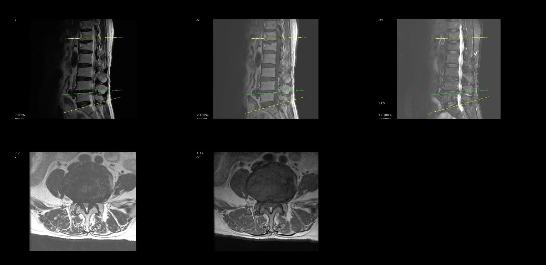 De-identified preoperative axial lumbar MRI demonstrating severe stenosis.