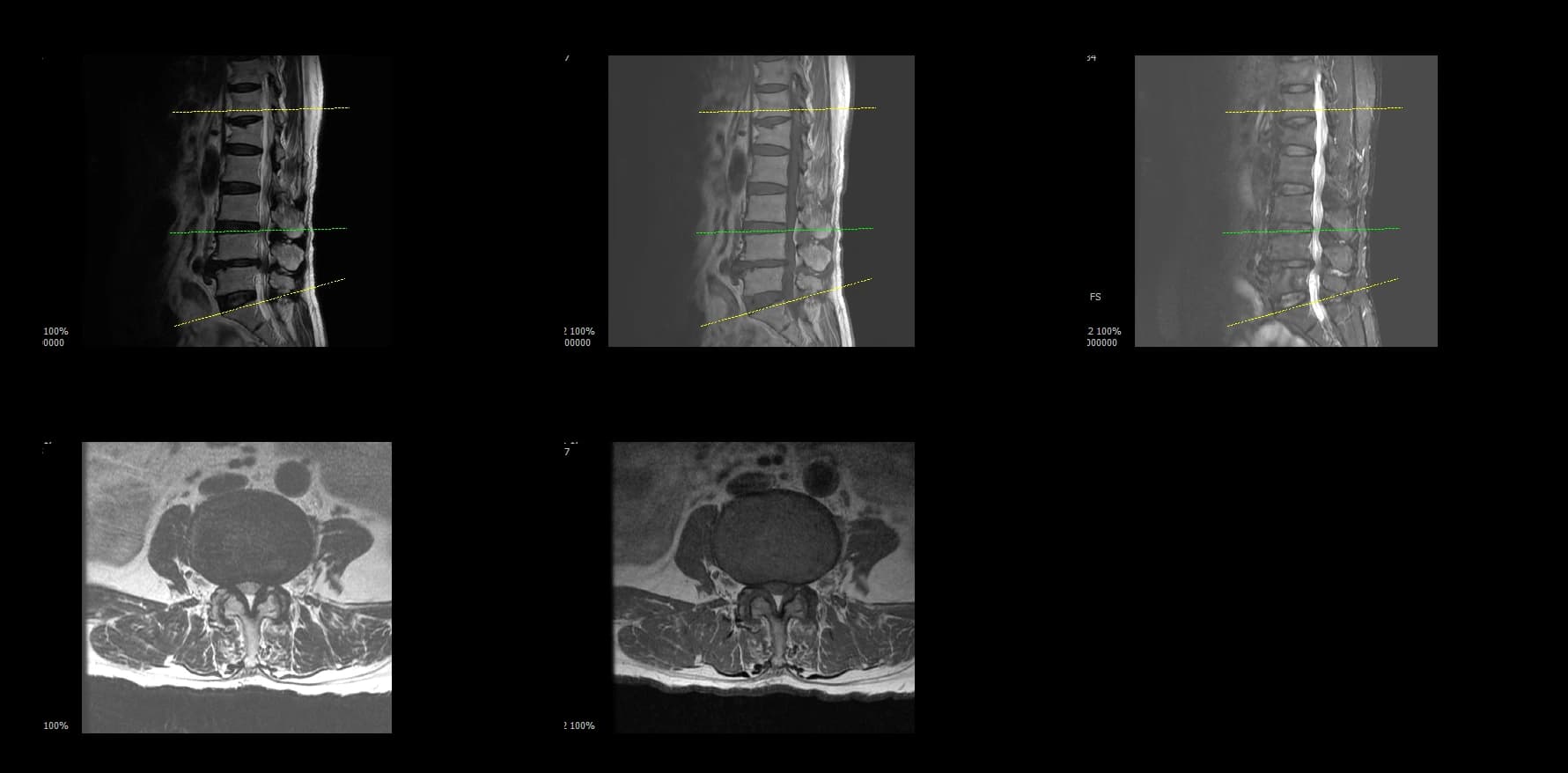 De-identified preoperative sagittal lumbar MRI demonstrating severe stenosis.