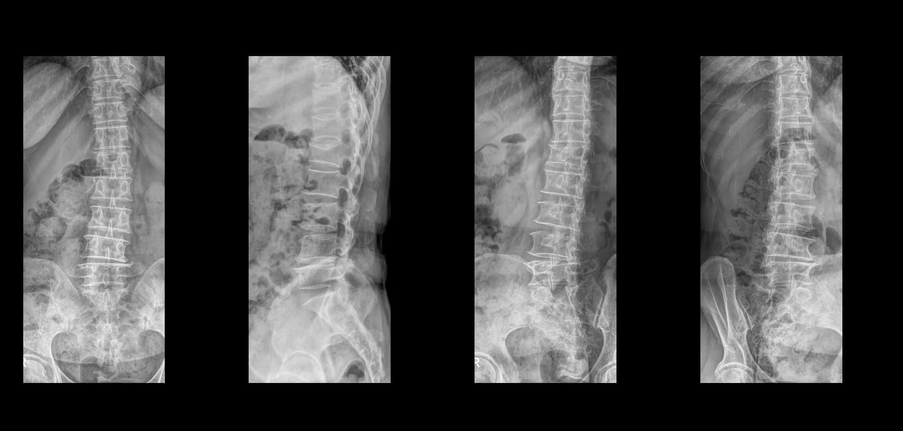 De-identified preoperative lumbar radiograph for severe lumbar spinal stenosis case.