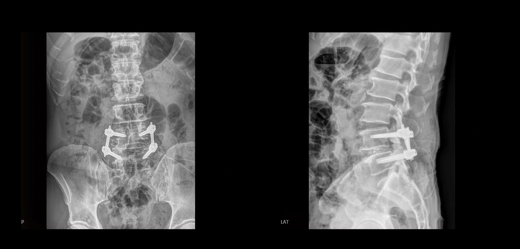 De-identified postoperative lumbar radiograph after L4-L5 UBE-TLIF.