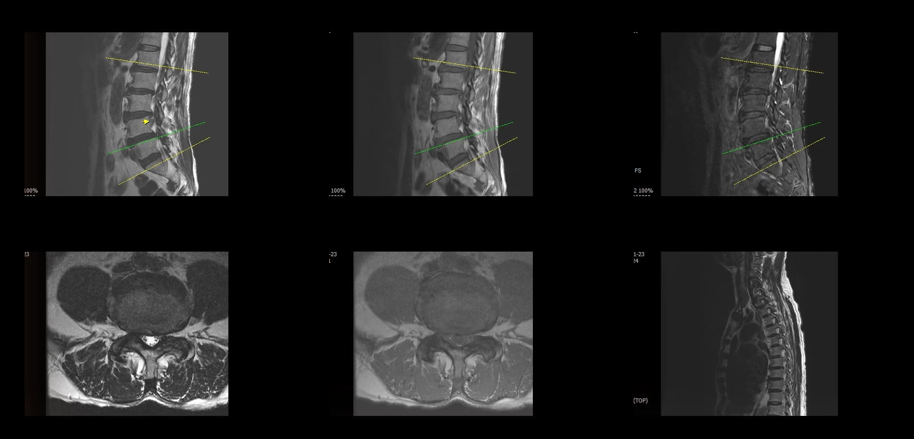 De-identified preoperative axial lumbar MRI demonstrating foraminal stenosis.