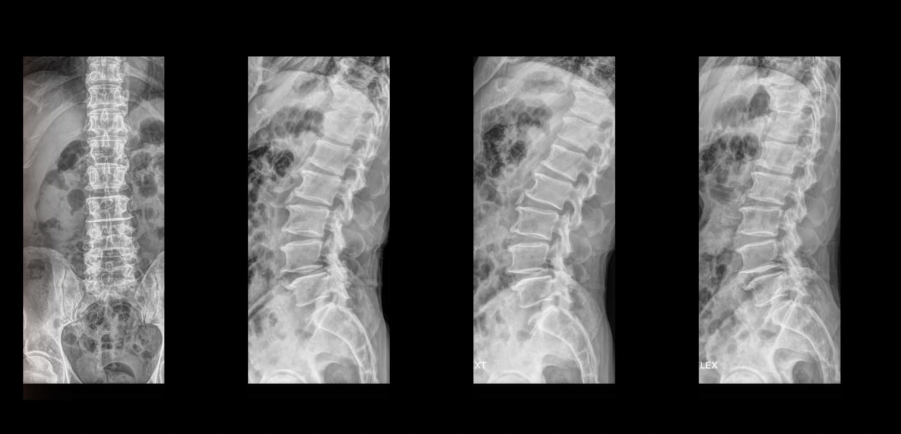 De-identified preoperative lumbar radiograph demonstrating degenerative spondylolisthesis.