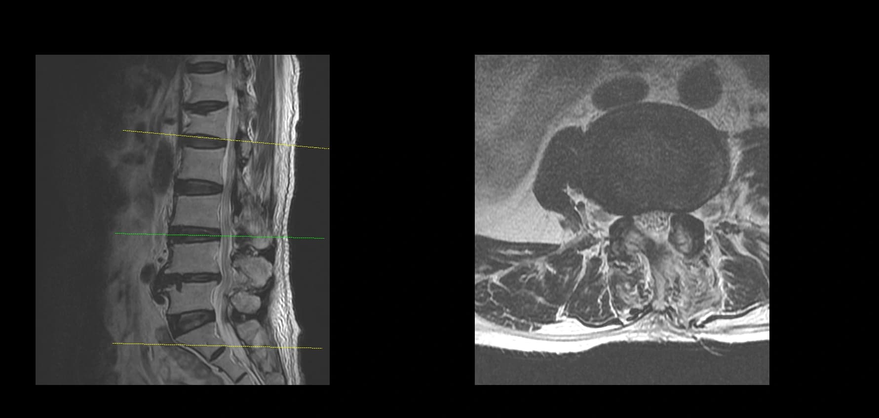 De-identified postoperative sagittal lumbar MRI after revision endoscopic fusion.