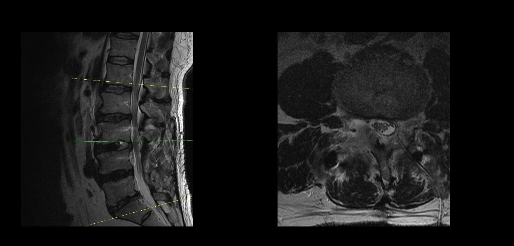 De-identified postoperative lumbar radiograph after extension fusion.
