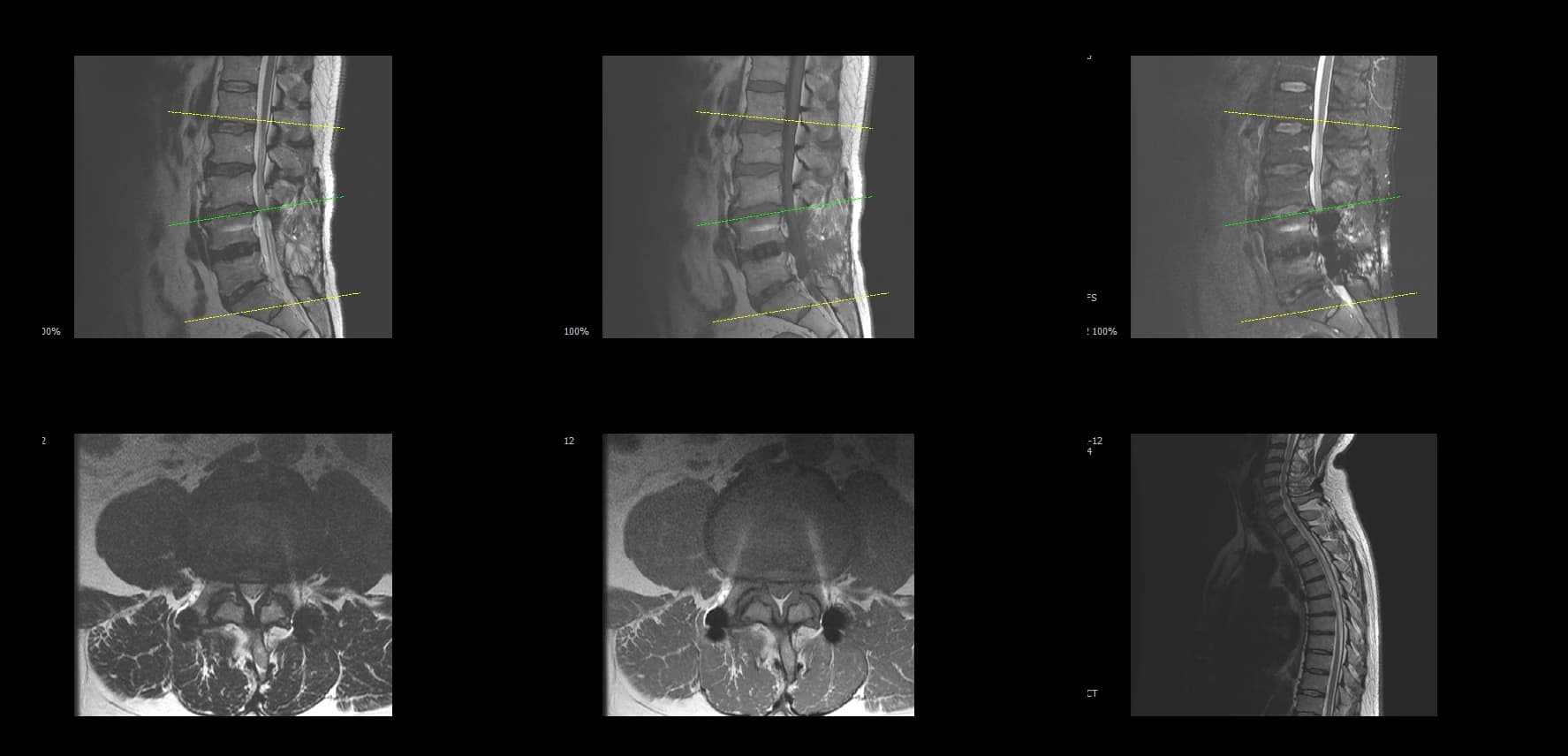De-identified preoperative sagittal lumbar MRI demonstrating adjacent segment disease.