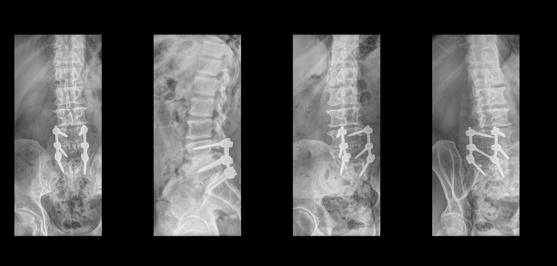 De-identified preoperative lumbar radiograph demonstrating prior fusion construct.