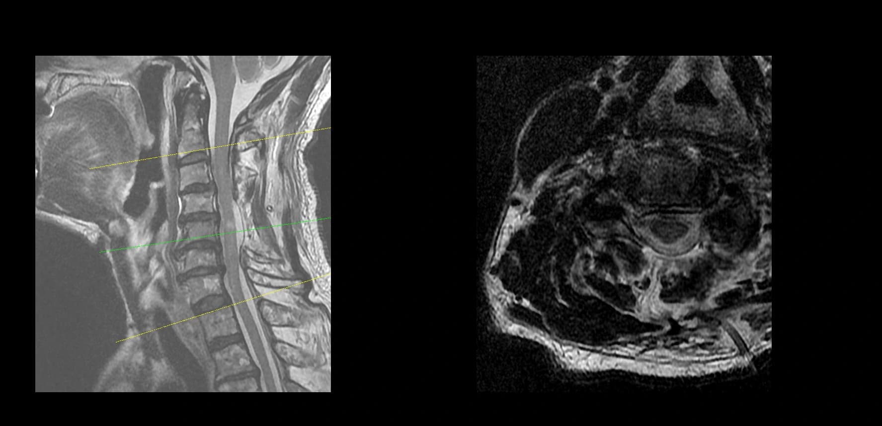 De-identified postoperative axial cervical MRI after decompression.