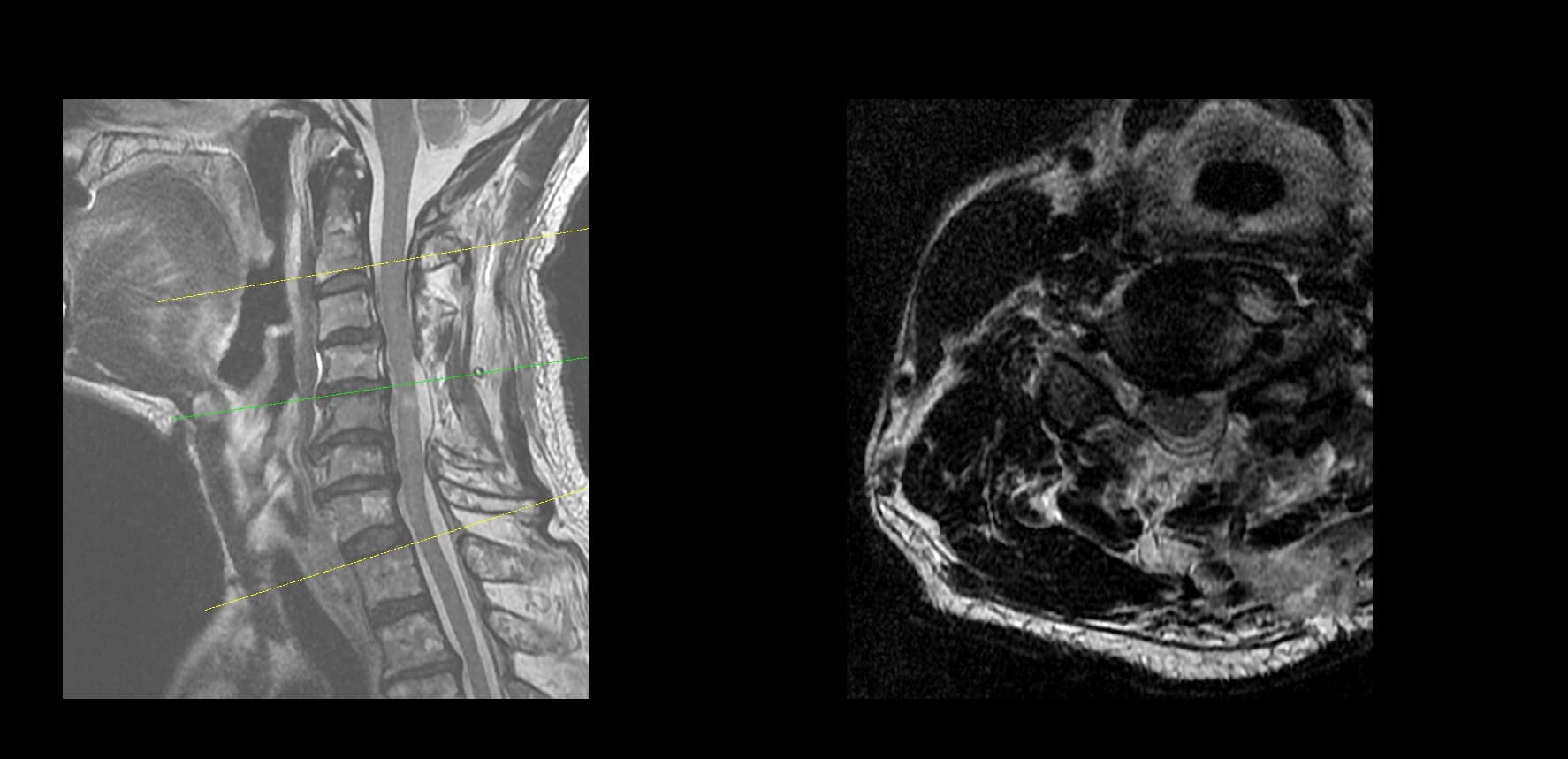 De-identified postoperative sagittal cervical MRI after endoscopic decompression.