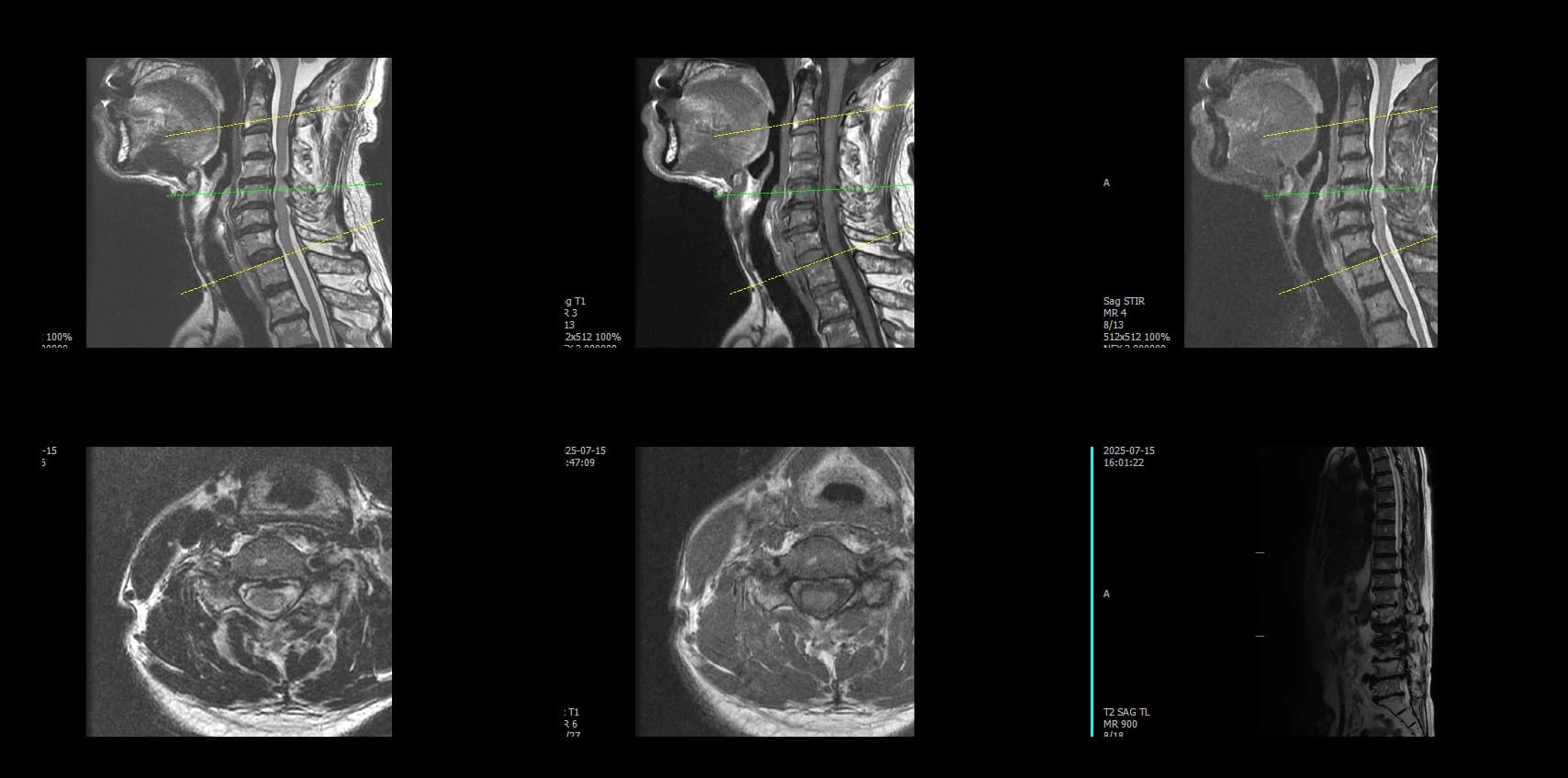 De-identified preoperative axial cervical MRI demonstrating cervical stenosis.